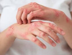 Berau Bebas Frambusia